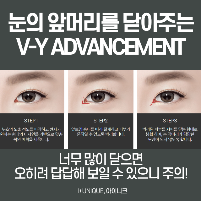 앞트임재수술 이번엔 제대로! 관련 이미지 3