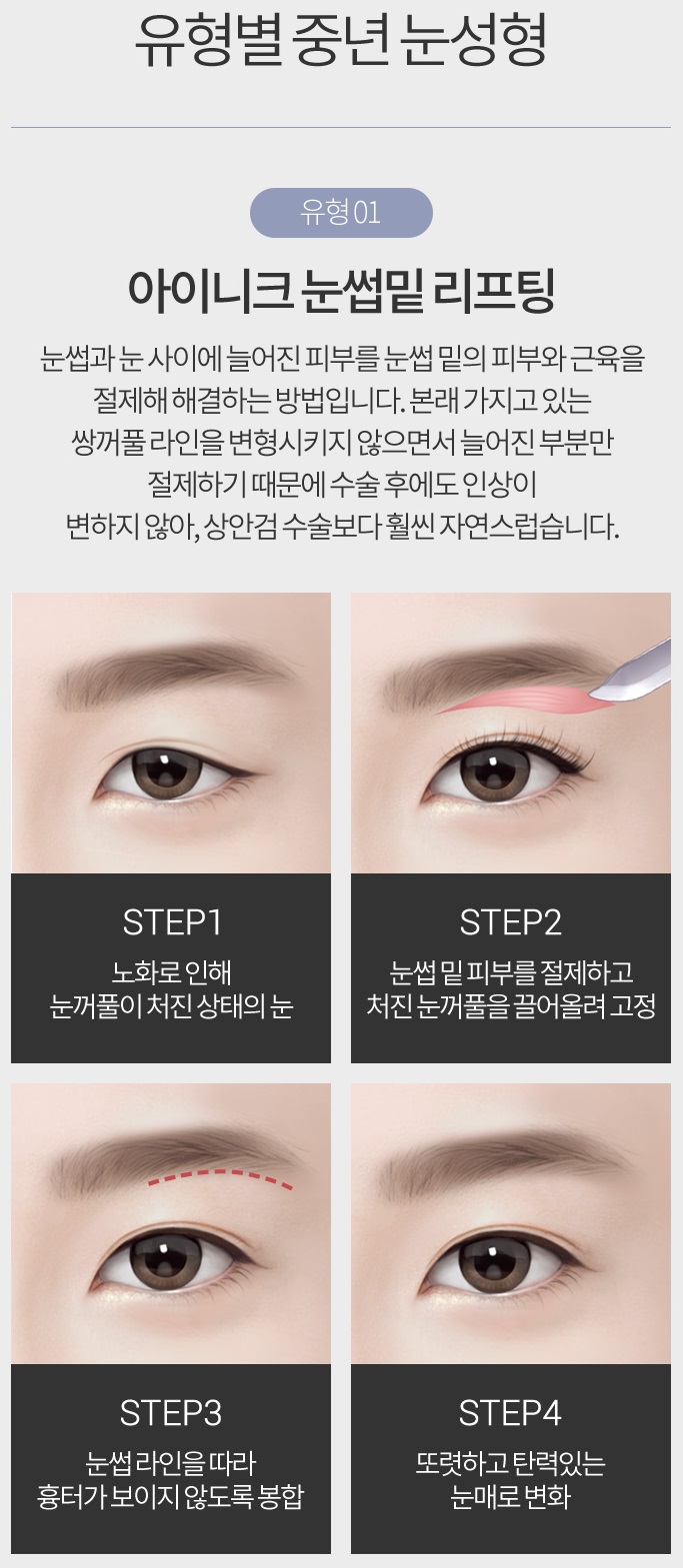 상안검성형술로 다시 20대의 눈매! 관련 이미지 4