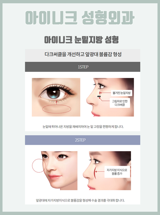 다크서클지방이식 볼륨감을 더해 생기 있는 얼굴로! 관련 이미지 3