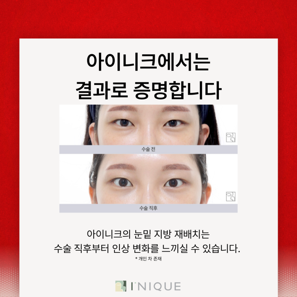 눈밑지방성형 어떤 방식이 좋을까? 관련 이미지 5