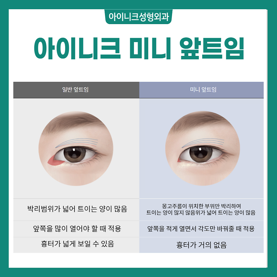 뒤트임잘하는곳 찾고 있나요? 관련 이미지 3