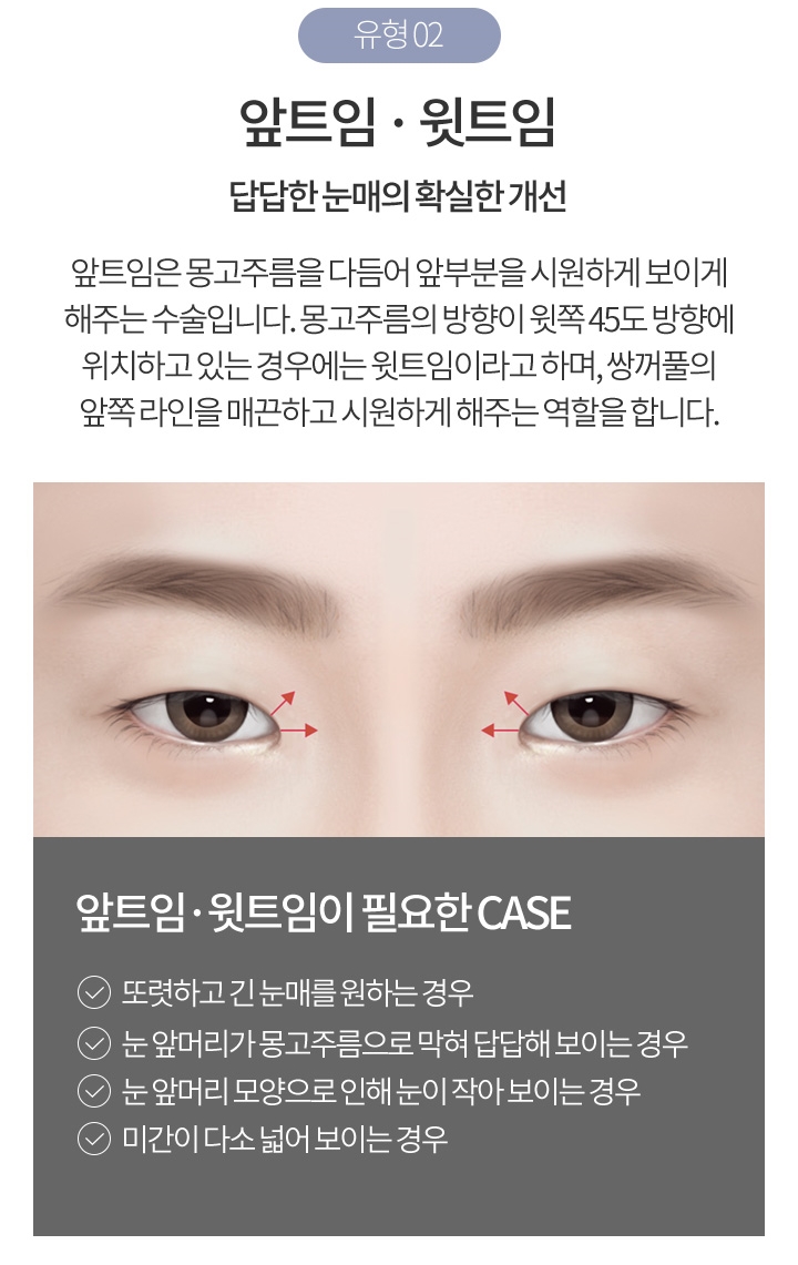 눈앞뒤트임 또렷한 눈매로 변신! 관련 이미지 5