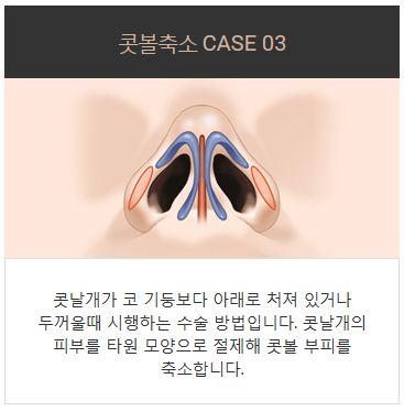 콧구멍축소수술가격 작지만 큰 효과 관련 이미지 5