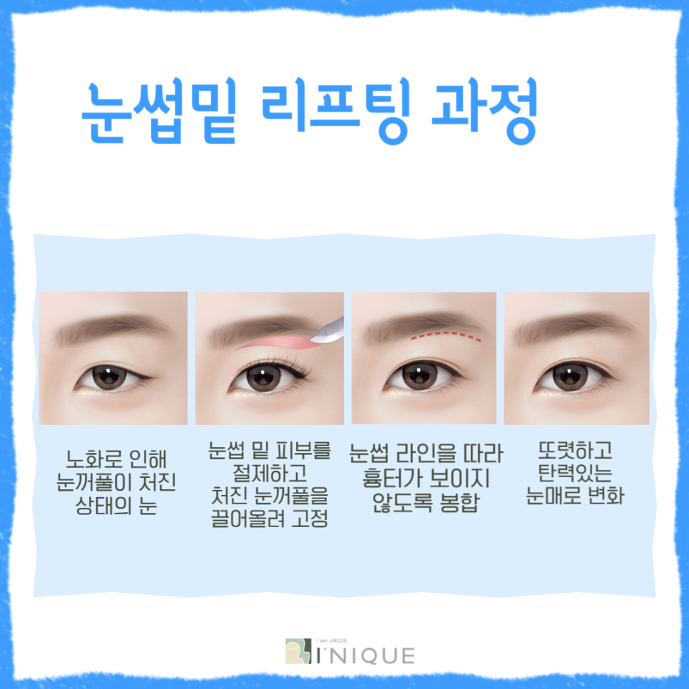 For a Brighter, More Youthful Impression with Midlife Eye Surgery image 4