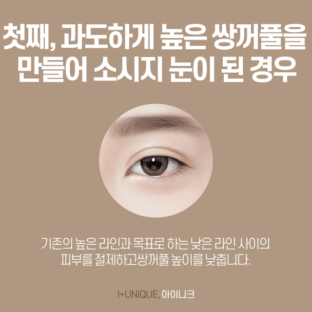 How Can Double Eyelid Line Reduction Be Done? image 4