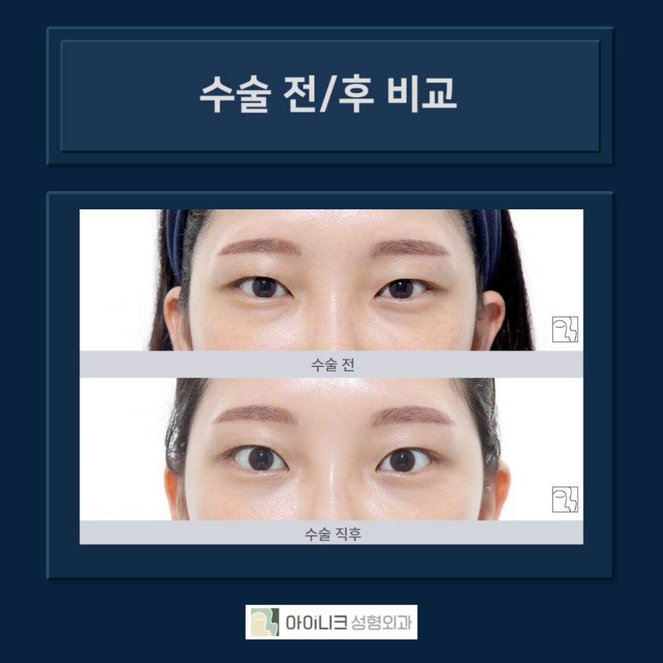 다크서클제거수술, 보다 확실한 방법으로 관련 이미지 6