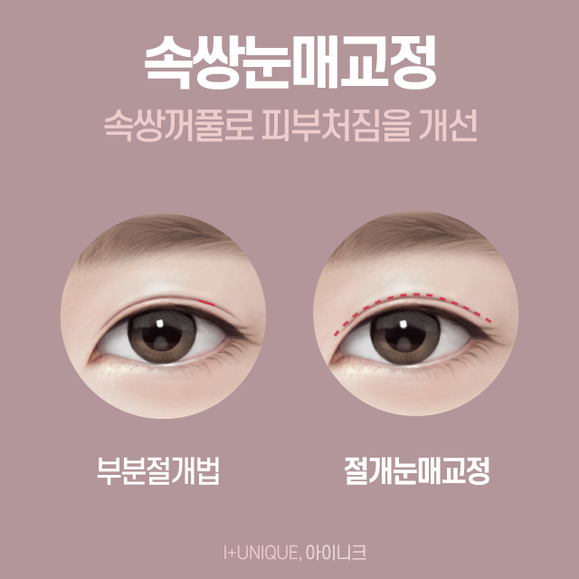 남녀노소 가능한 눈매교정술 그리고 가격까지 한 번에 알아보자! 관련 이미지 5