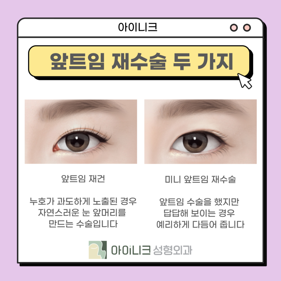 눈재수술성형외과 실패한 앞트임 재건 관련 이미지 9