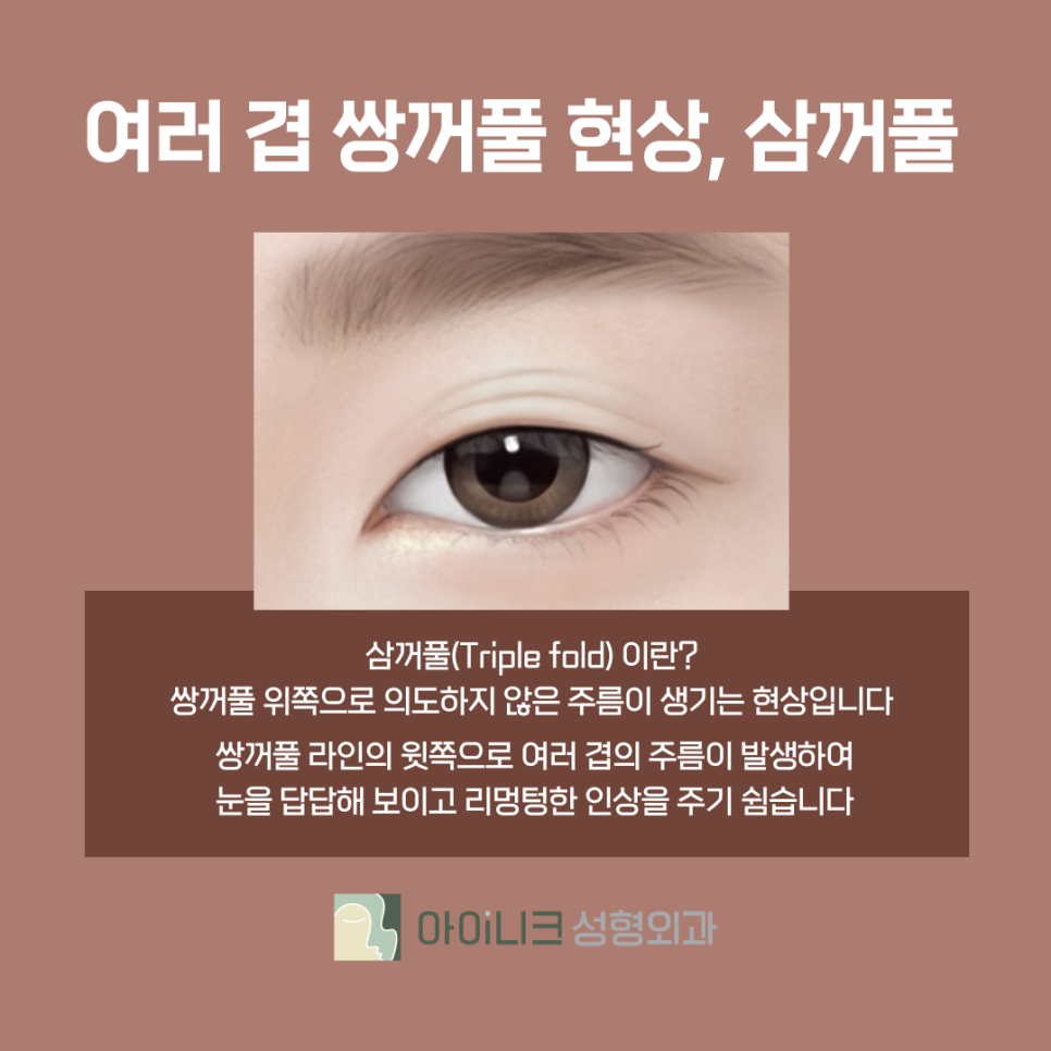 쌍수절개재수술 3중 고정으로 견고하게 관련 이미지 5