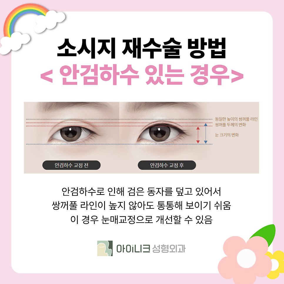 Revision Surgery for “Sausage Eyes”: How Should Thick Double-Eyelid Folds Be Corrected? image 4