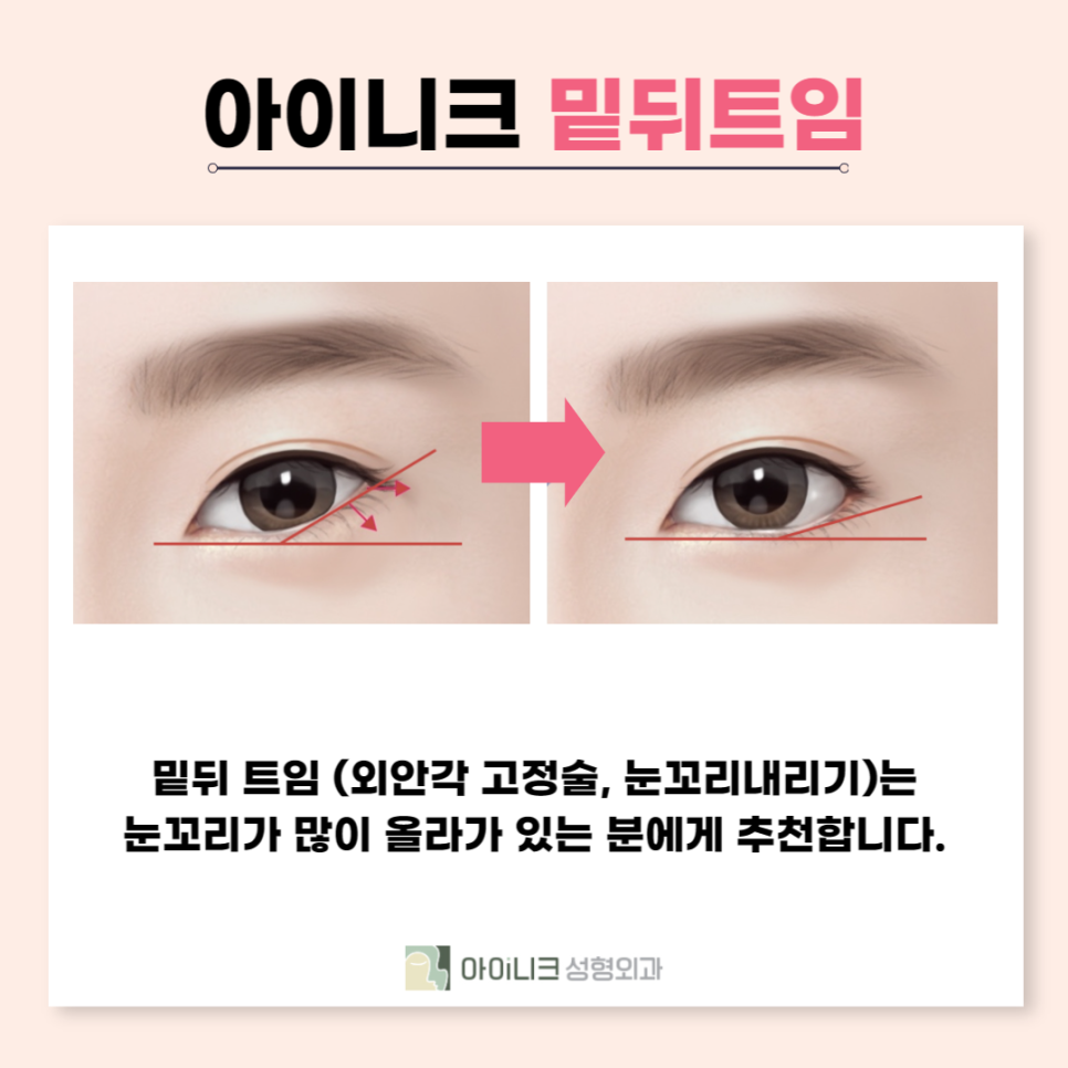 눈꼬리수술로 강아지상 만든 후기 관련 이미지 3