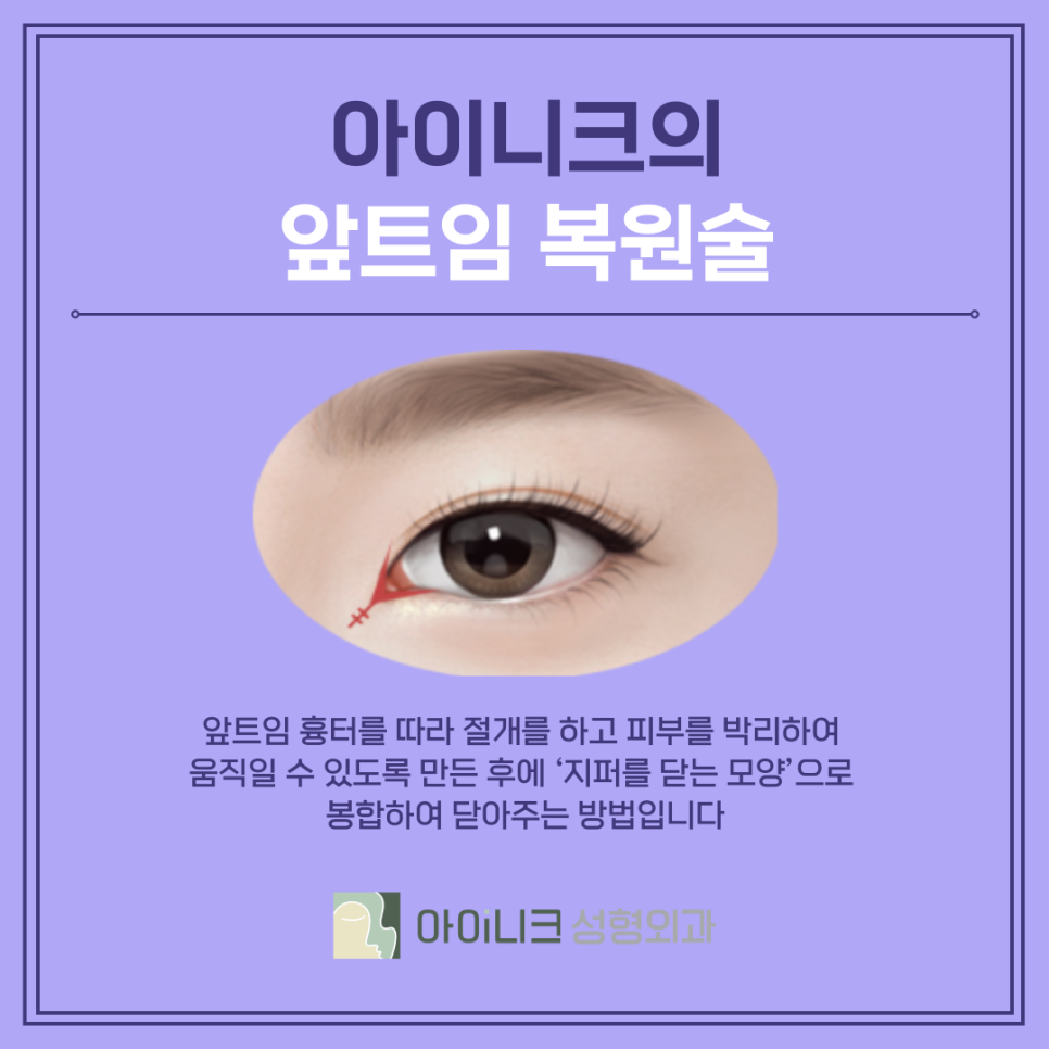 압구정눈재수술잘하는곳 실패를 성공으로 바꾸기 관련 이미지 7