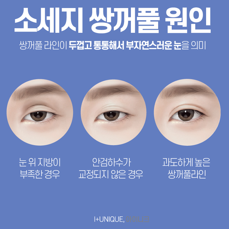 쌍꺼풀라인낮추기 방법을 알아보고 있다면 아이니크성형외과에서상담받자 관련 이미지 2
