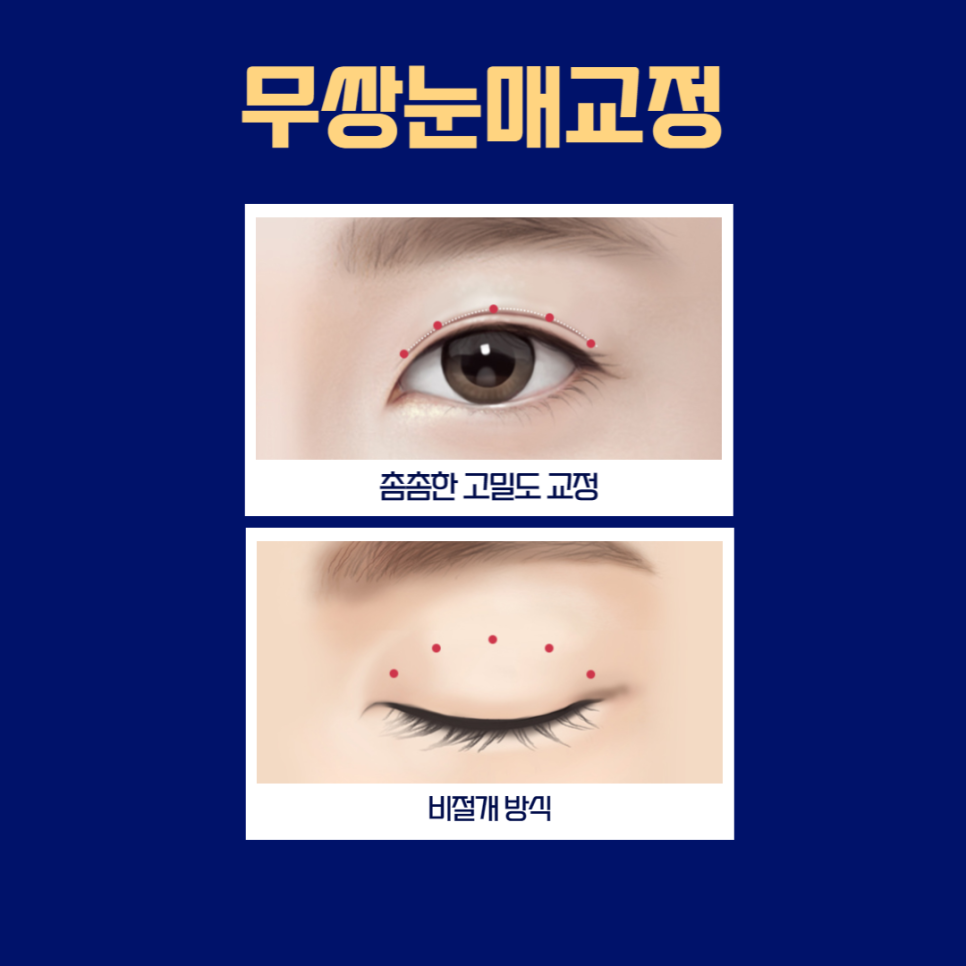 남자눈성형잘하는곳, 자연스럽고 또렷한 눈! 관련 이미지 4