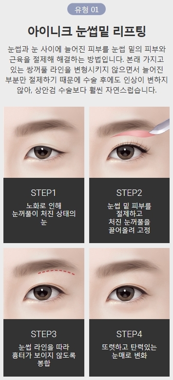 하안검수술가격 합리적인 아이니크에서 동안 얼굴로 개선! 관련 이미지 3
