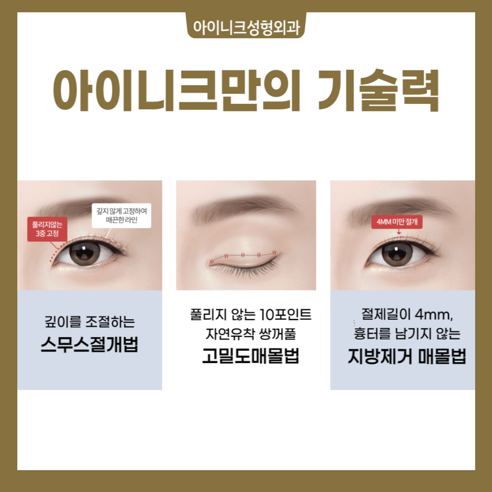 쌍꺼풀 절개법 매몰법 차이점은? 관련 이미지 2