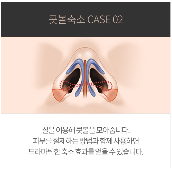 콧볼축소수술가격이 궁금하다면 click! 관련 이미지 5