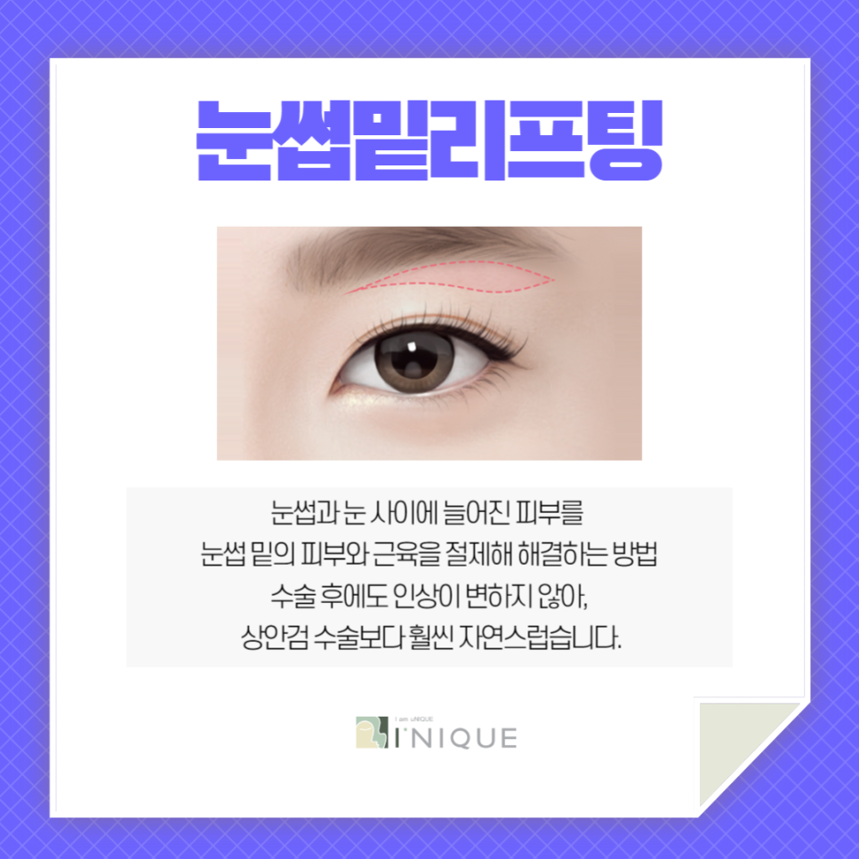 Double Eyelid Surgery in Your 40s, This Is the Perfect Option for Middle Age! image 2