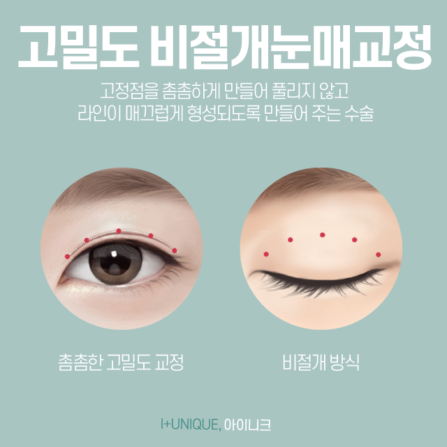 졸려보이는 눈을 또렷하게 안검하수병원추천 관련 이미지 4