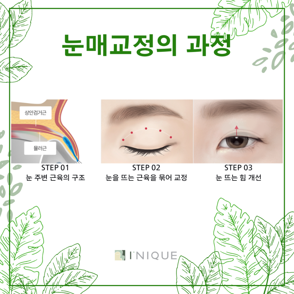 Droopy Eye Surgery, What Ptosis Means image 4