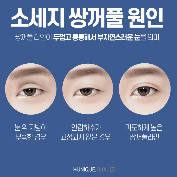 소세지쌍꺼풀이 고민이라면 아이니크성형외과를 오면 답이 있다 관련 이미지 2