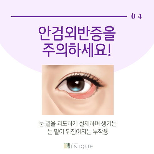 Restoring a Lively Eye Appearance with Drooping Eye Surgery image 5