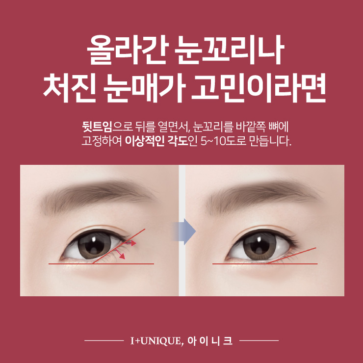 부작용 심한 뒤트임 아이니크성형외과에서 신중하게 관련 이미지 4