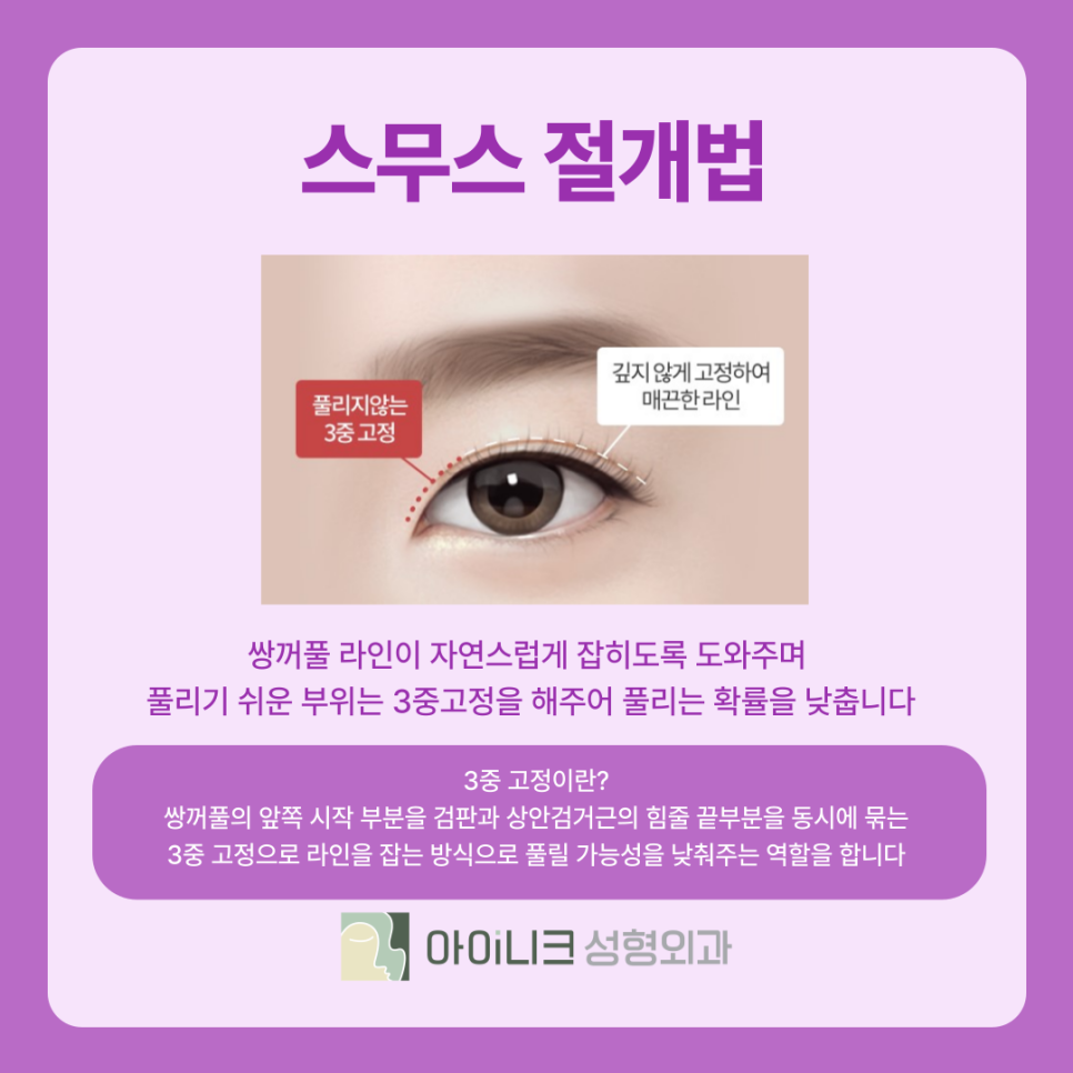 압구정 쌍꺼풀 수술 라인의 종류와 나에게 맞는 방법은? 관련 이미지 7