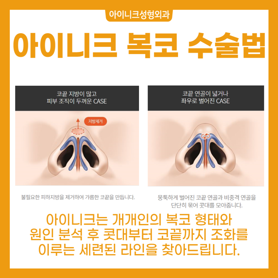 남자코성형후기 모음 - 낮은 코, 매부리코, 미간꺼짐 개선 효과를 확인해보세요 관련 이미지 7