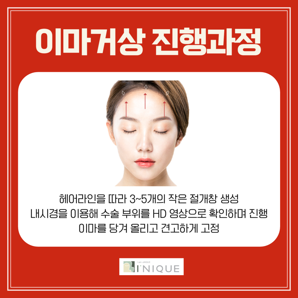 If You Want to Remove Forehead Wrinkles Properly image 3