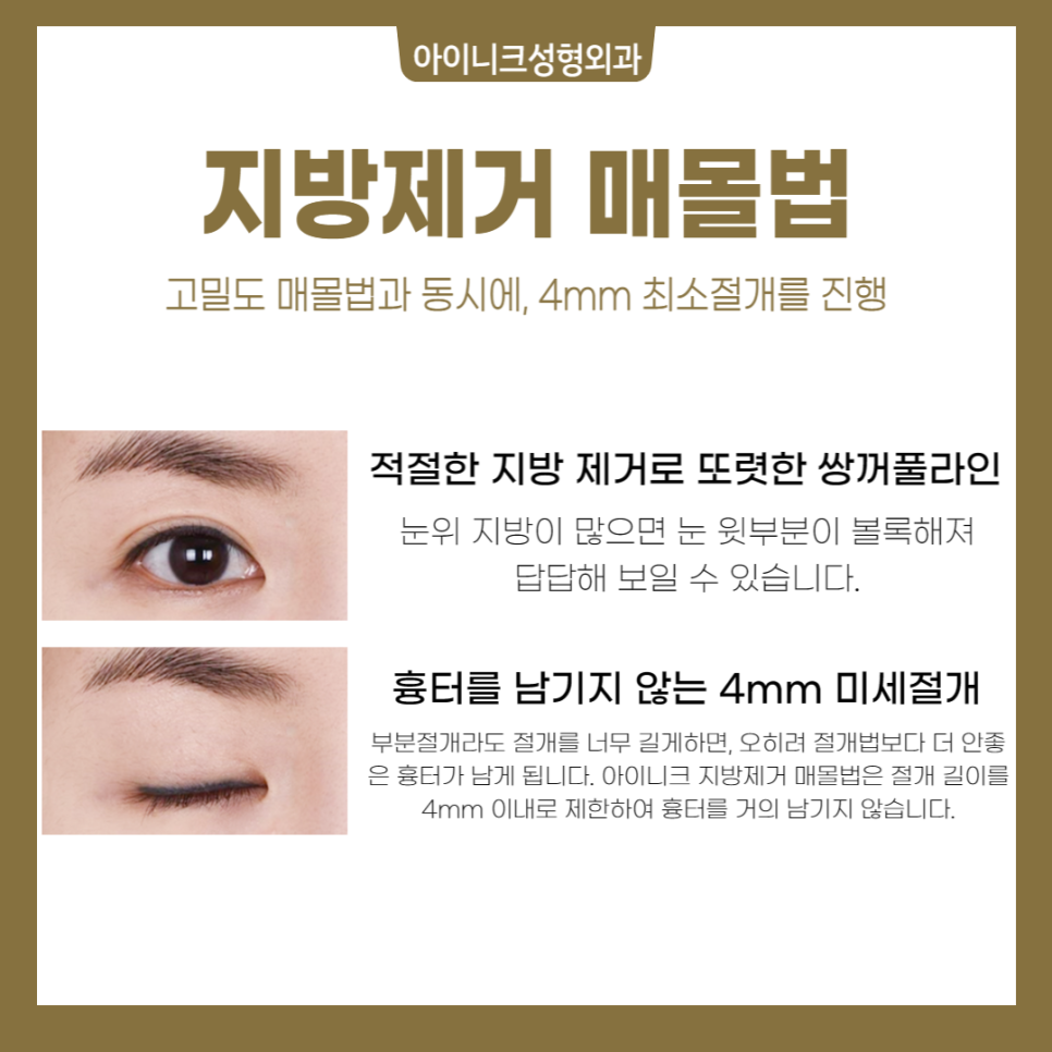 쌍꺼풀 절개법 매몰법 차이점은? 관련 이미지 5
