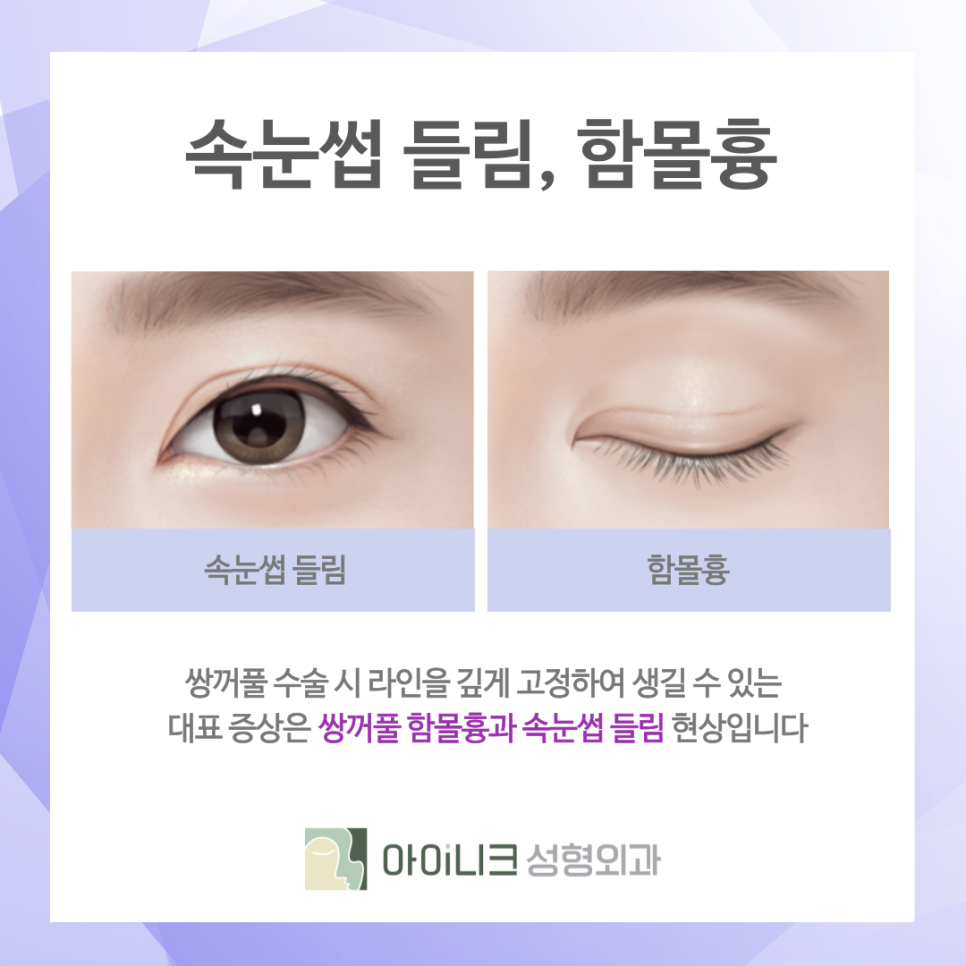 청담동 쌍꺼풀수술 추천 흉터를 줄이는 방식 관련 이미지 5