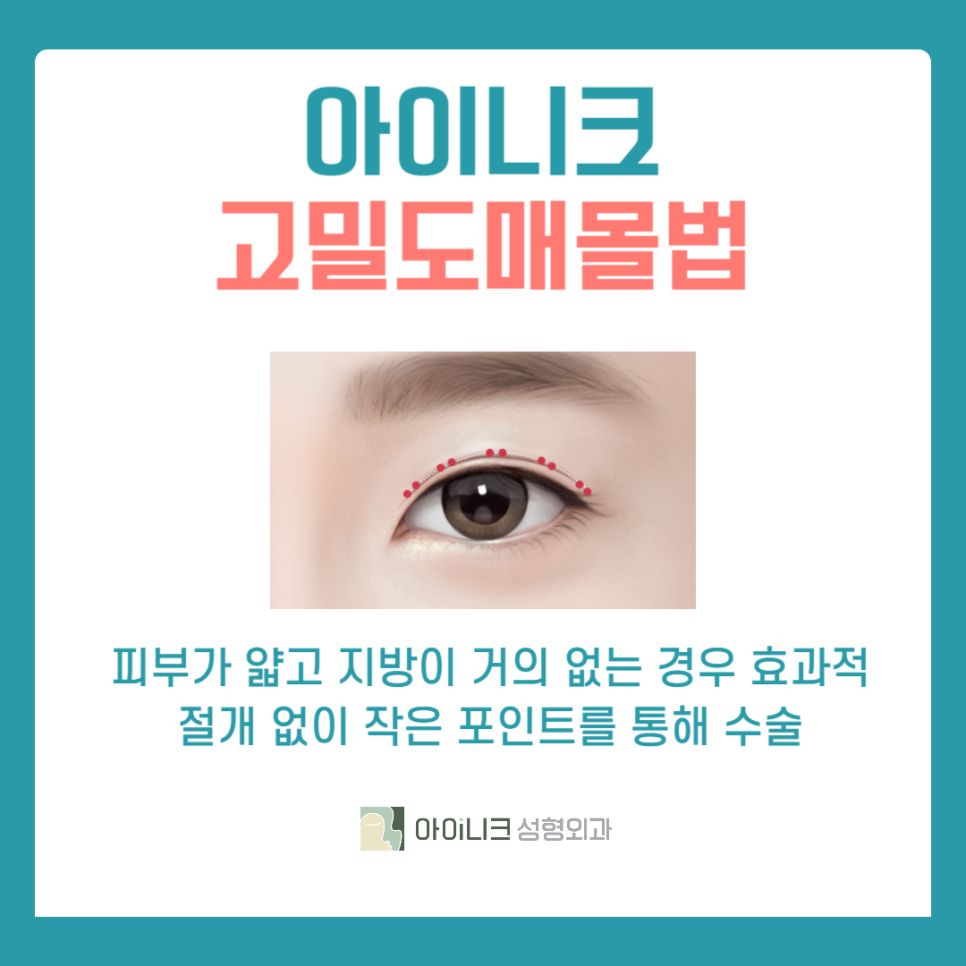 Recommended Eye Surgery for Men: If You Want Softer Eyes image 4