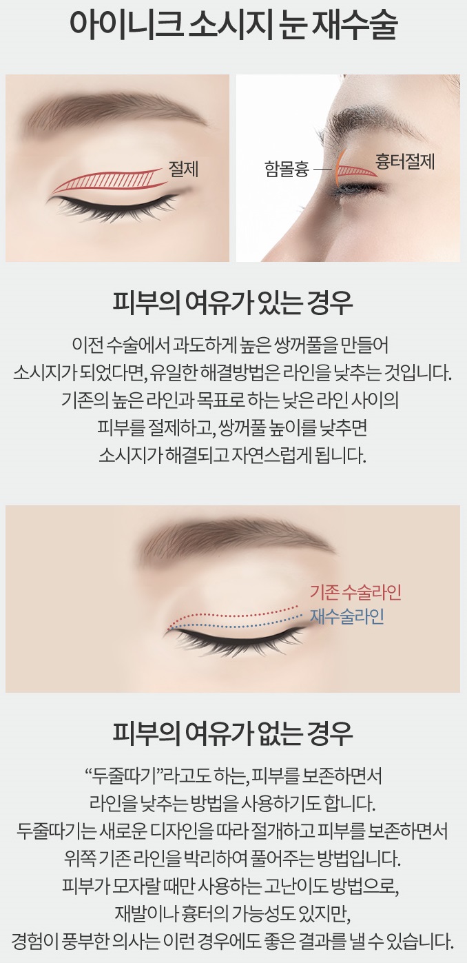 소시지쌍꺼풀 원인부터 파악하자! 관련 이미지 4