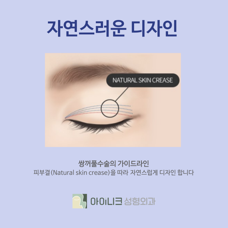 강남성형외과 아이니크의 자연스럽고 예쁜 쌍꺼풀 관련 이미지 7
