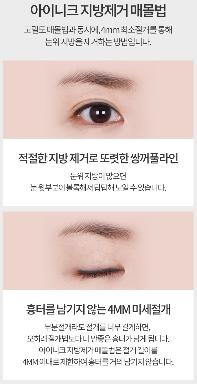 쌍꺼풀수술자국 걱정 없이 예쁘게! 관련 이미지 6