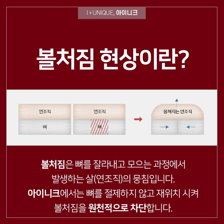 모든 각도에서 예쁘도록 ㅇㅇㄴㅋ 성형 광대축소 관련 이미지 3