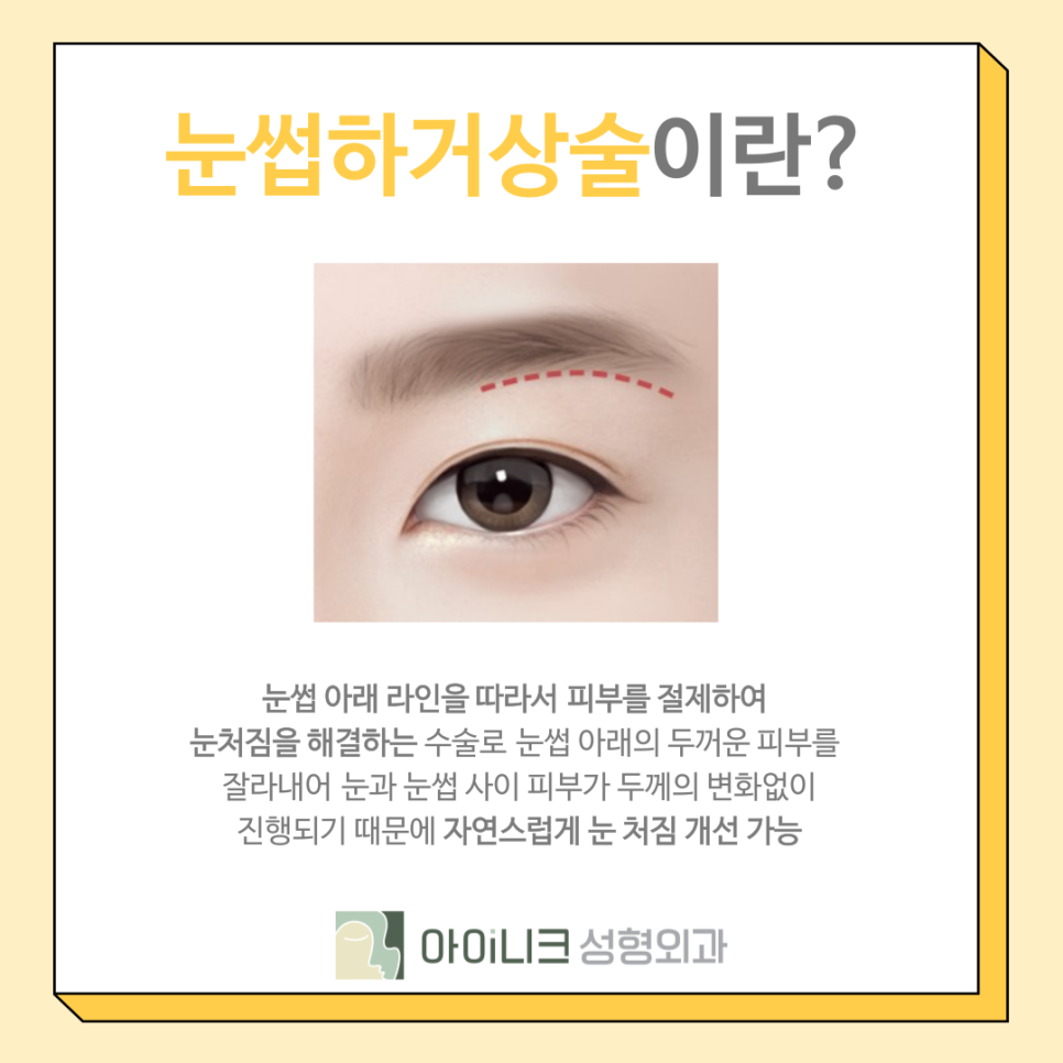 A Plan for Lower-Eyelid Surgery in Your 50s for Middle-Aged Men image 7