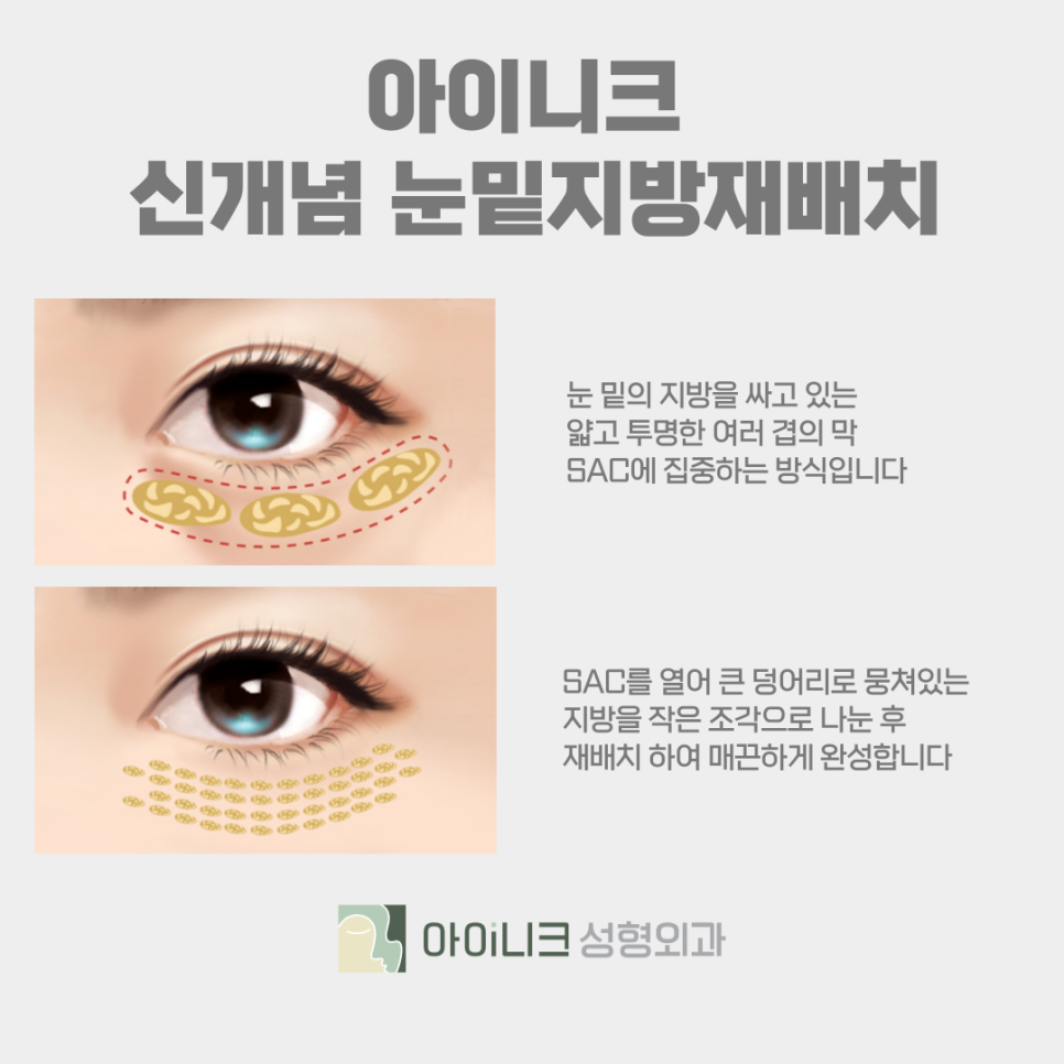 압구정 눈밑꺼짐 현상을 개선하는 눈밑지방재배치 관련 이미지 6