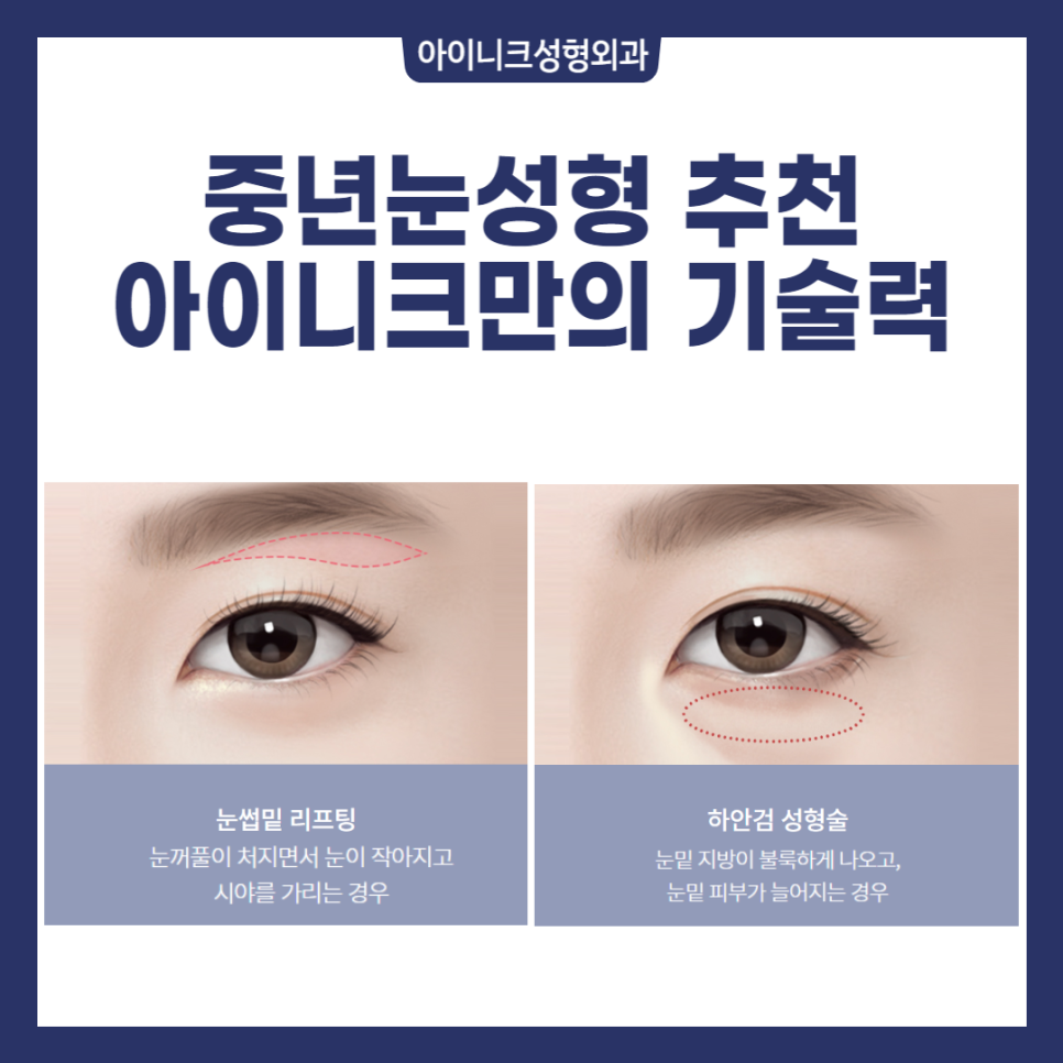 40대중년눈성형, 많이 하나요? 관련 이미지 2