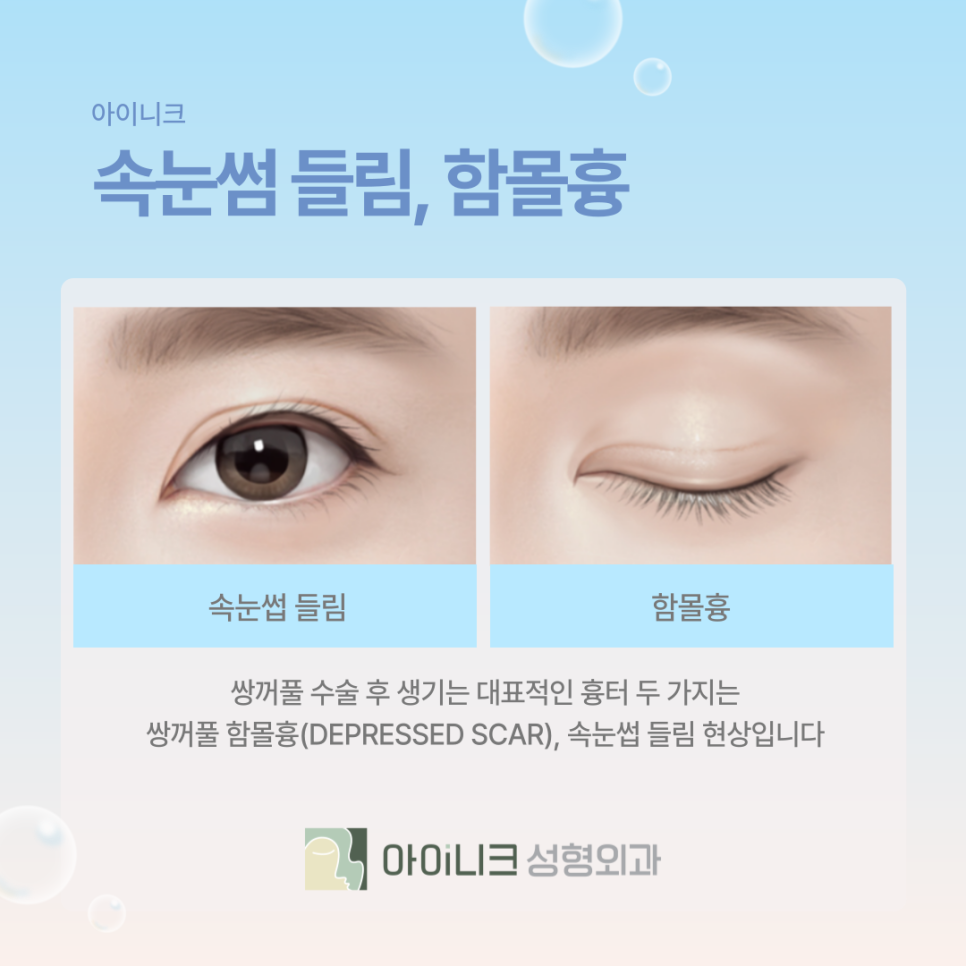 쌍꺼풀성형외과 흉터가 남을까 걱정된다면? 관련 이미지 6