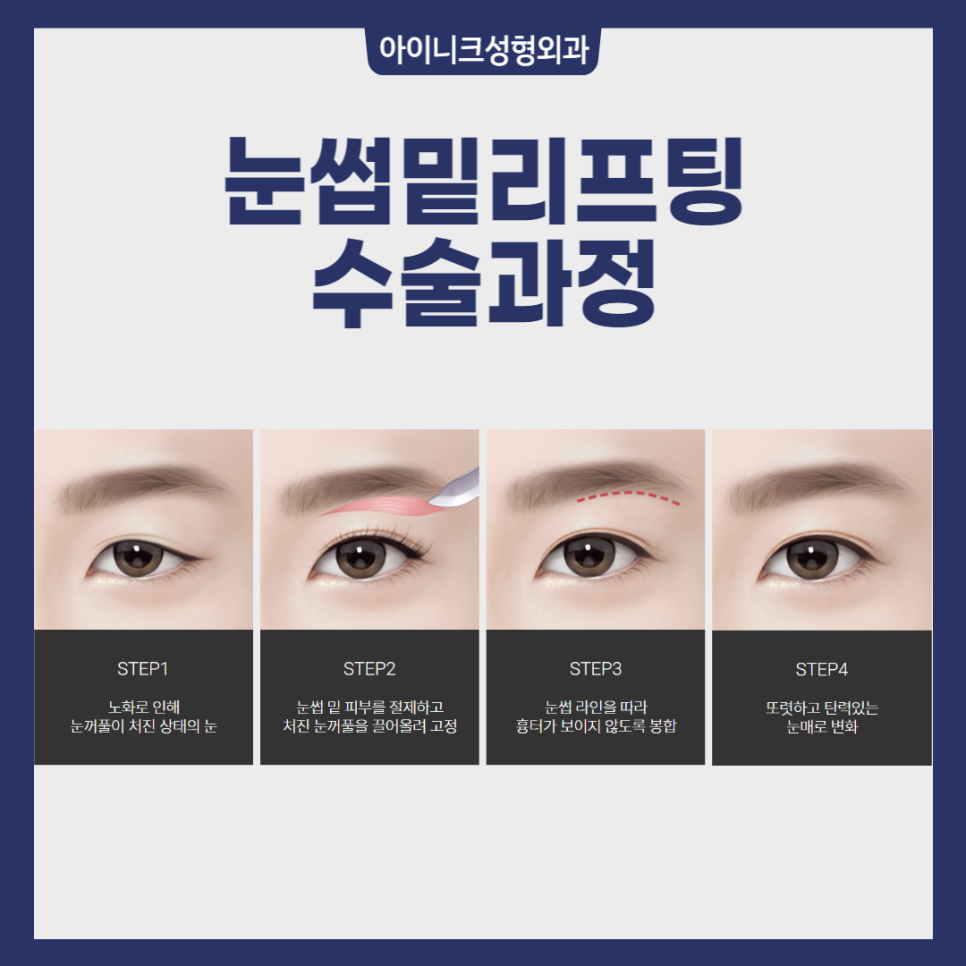 40대중년눈성형, 많이 하나요? 관련 이미지 5