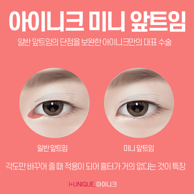 강남눈성형외과에서 트임수술을 원한다면 아이니크에서 알아보자 관련 이미지 3