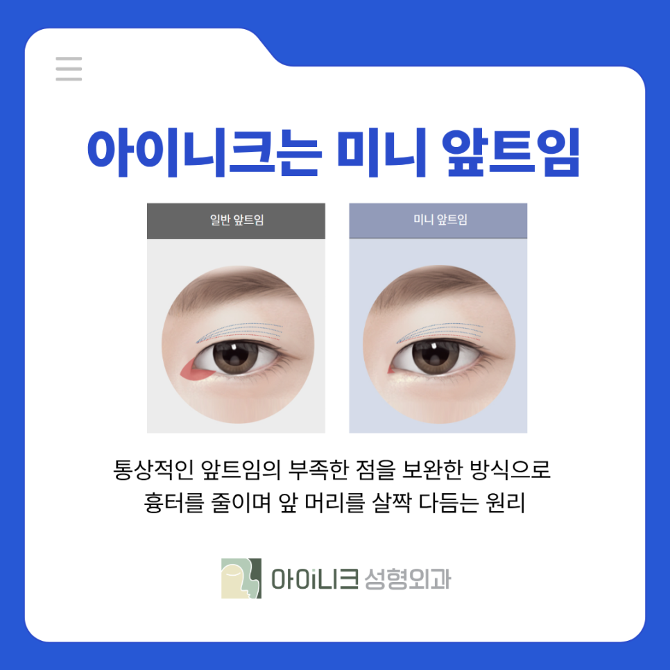남자눈수술 앞트임으로 또렷하고 남성스럽게 관련 이미지 6