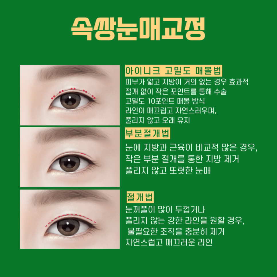 Points to Note for Male Eye Surgery image 3