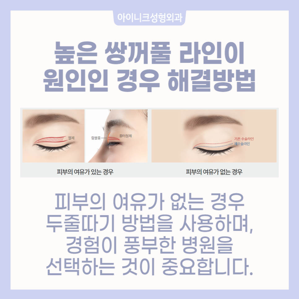 소세지눈재수술로 자연스러움을 되찾는 방법 관련 이미지 3