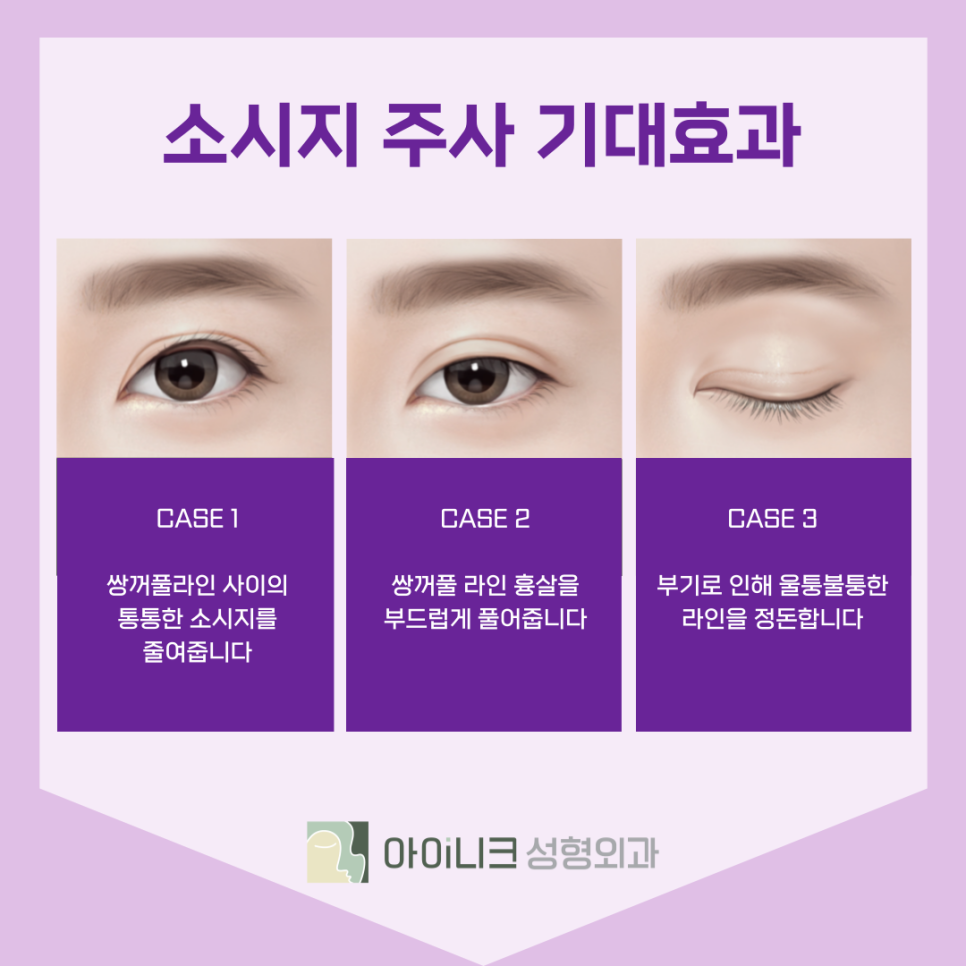 If You're Worried About Revision Double Eyelid Surgery Costs, Try the Sausage Injection! image 8
