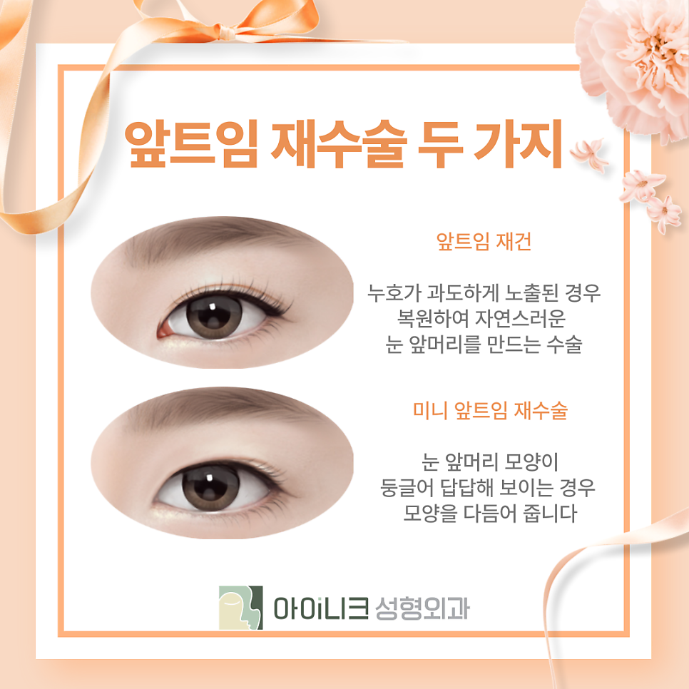 눈재수술잘하는곳 과도한 앞트임 재건이 문제라면 관련 이미지 10