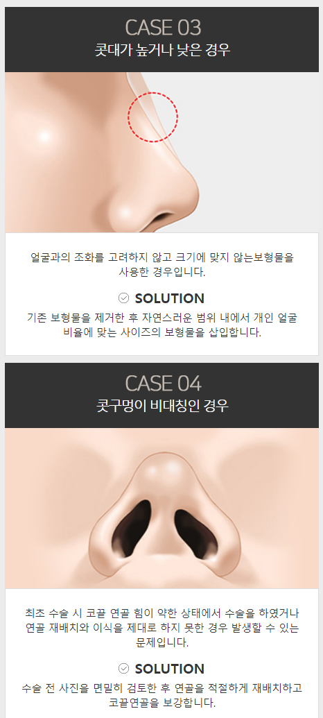 늑연골코재수술 안전한 보형물로 자연스럽게! 관련 이미지 4