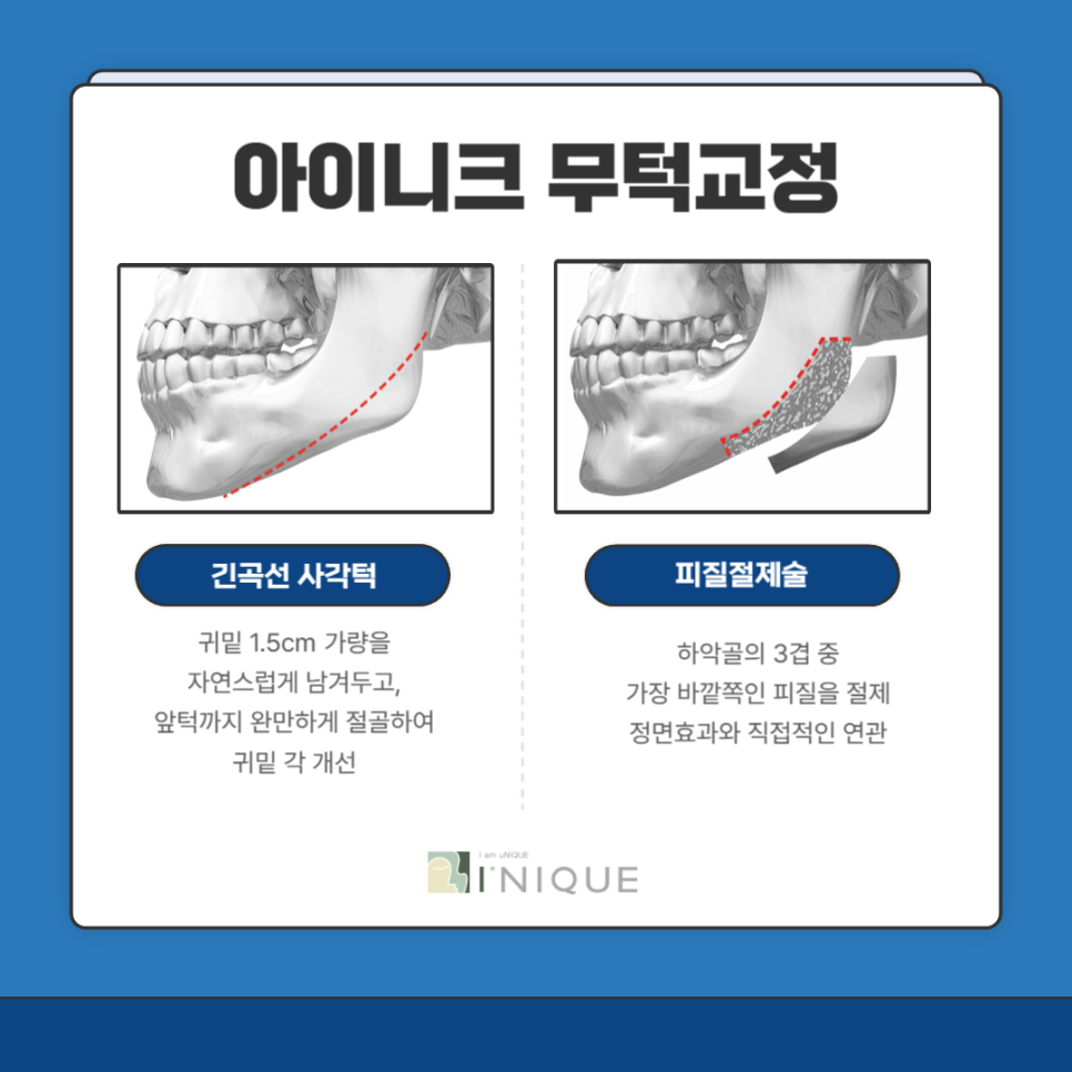 남자안면윤곽수술잘하는곳 포인트! 관련 이미지 4